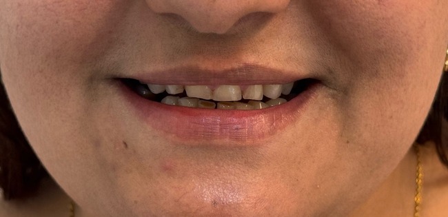 Antes de lentes de contato dental — paciente Templare Odontologia