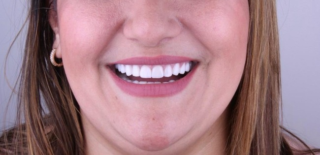 Depois de lentes de contato dental — paciente Templare Odontologia