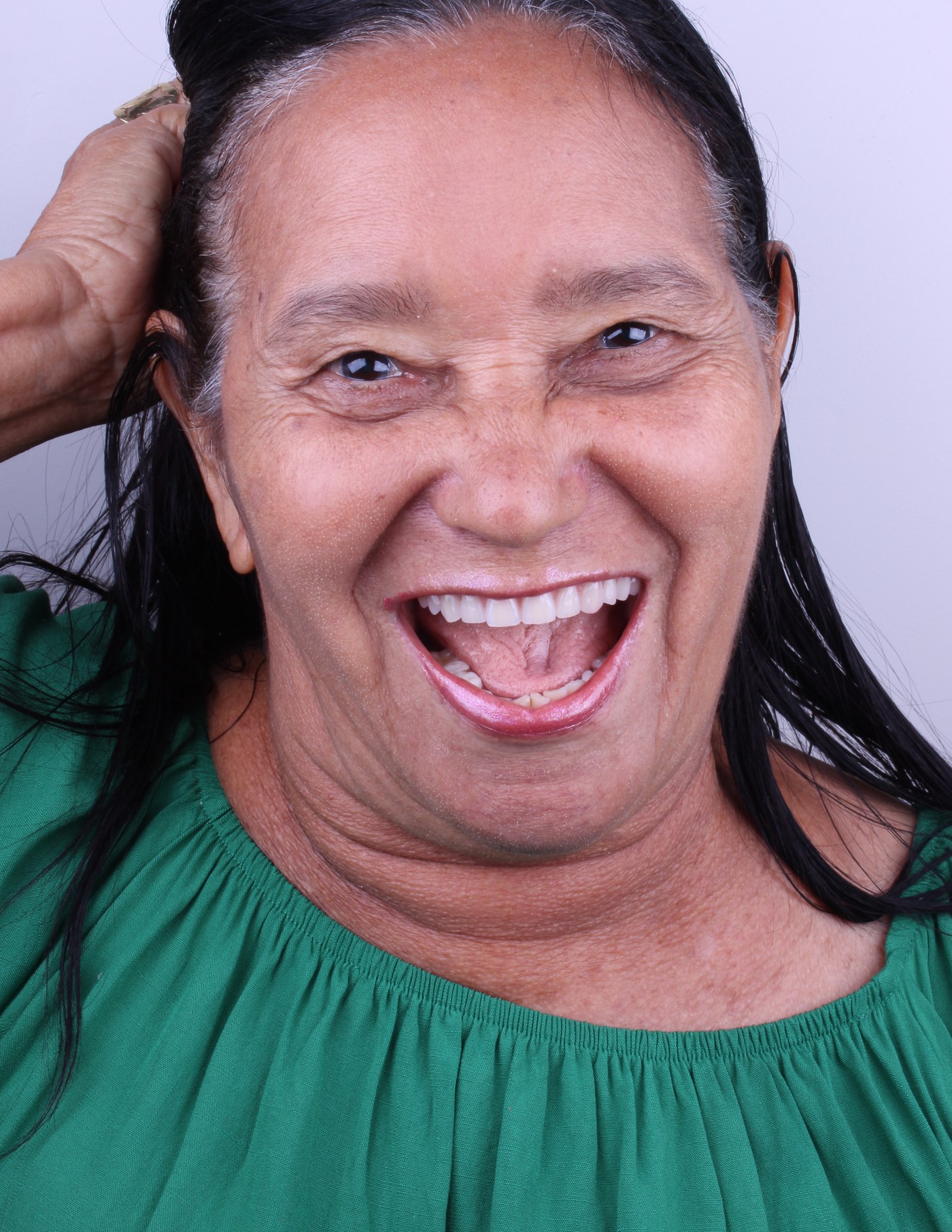 Resultado de implante dentário — paciente Templare Odontologia